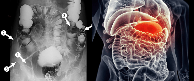 csepp férgek papilloma vírus és terhes